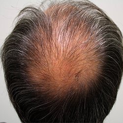 Alopecia Androgénica