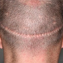 Alopecia Cicatricial