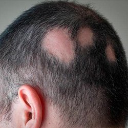 Alopecia Areata