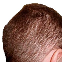 Alopecia Difusa