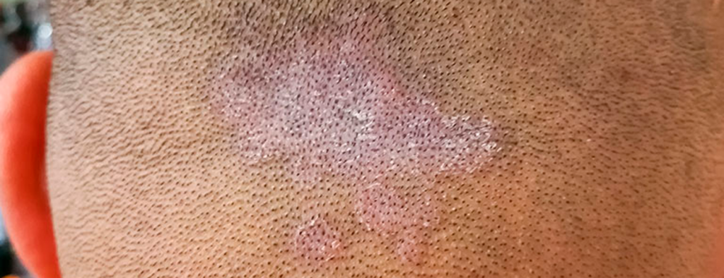 Hongos en la cabeza que producen caída de pelo
