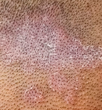 Hongos en la cabeza que producen caída de pelo