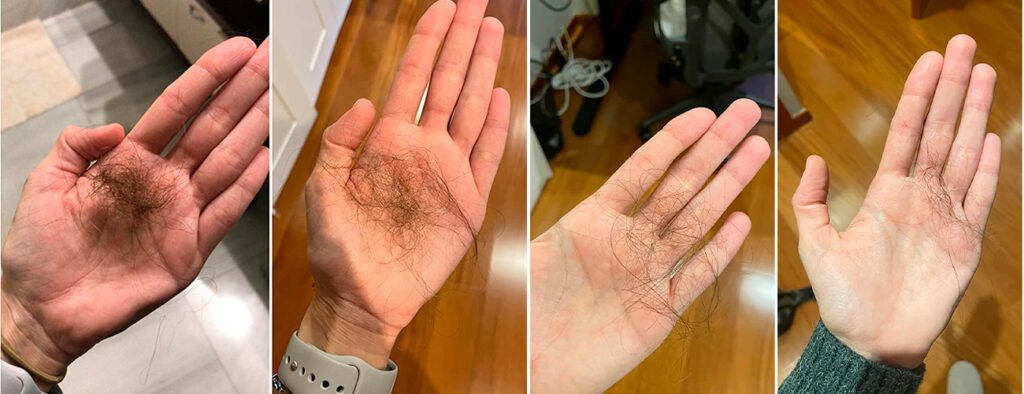 Isdin Cápsulas Anticaida Lambdapil 5 Alfa Plus Antes y Despues