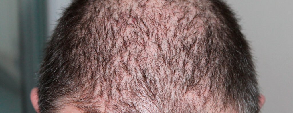 alopecia hombres